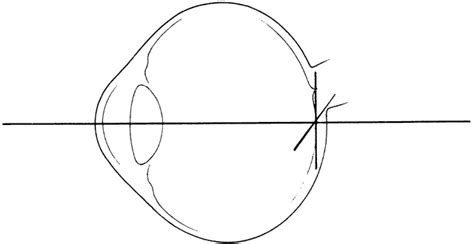 Volume 1, Chapter 39. Subjective Refraction: Fogging and